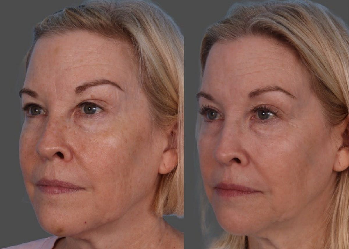 BBL (BroadBand Light)  Before & After Gallery - Patient 632702 - Image 3
