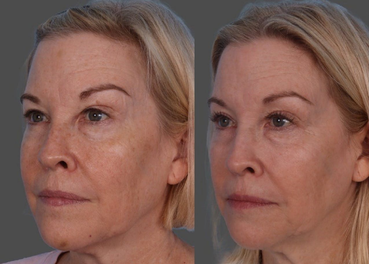 BBL (BroadBand Light)  Before & After Gallery - Patient 632702 - Image 3