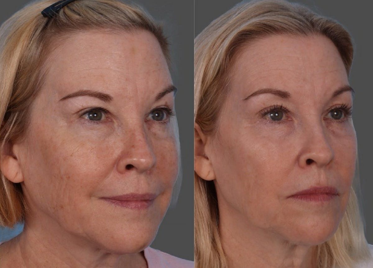 BBL (BroadBand Light)  Before & After Gallery - Patient 632702 - Image 2