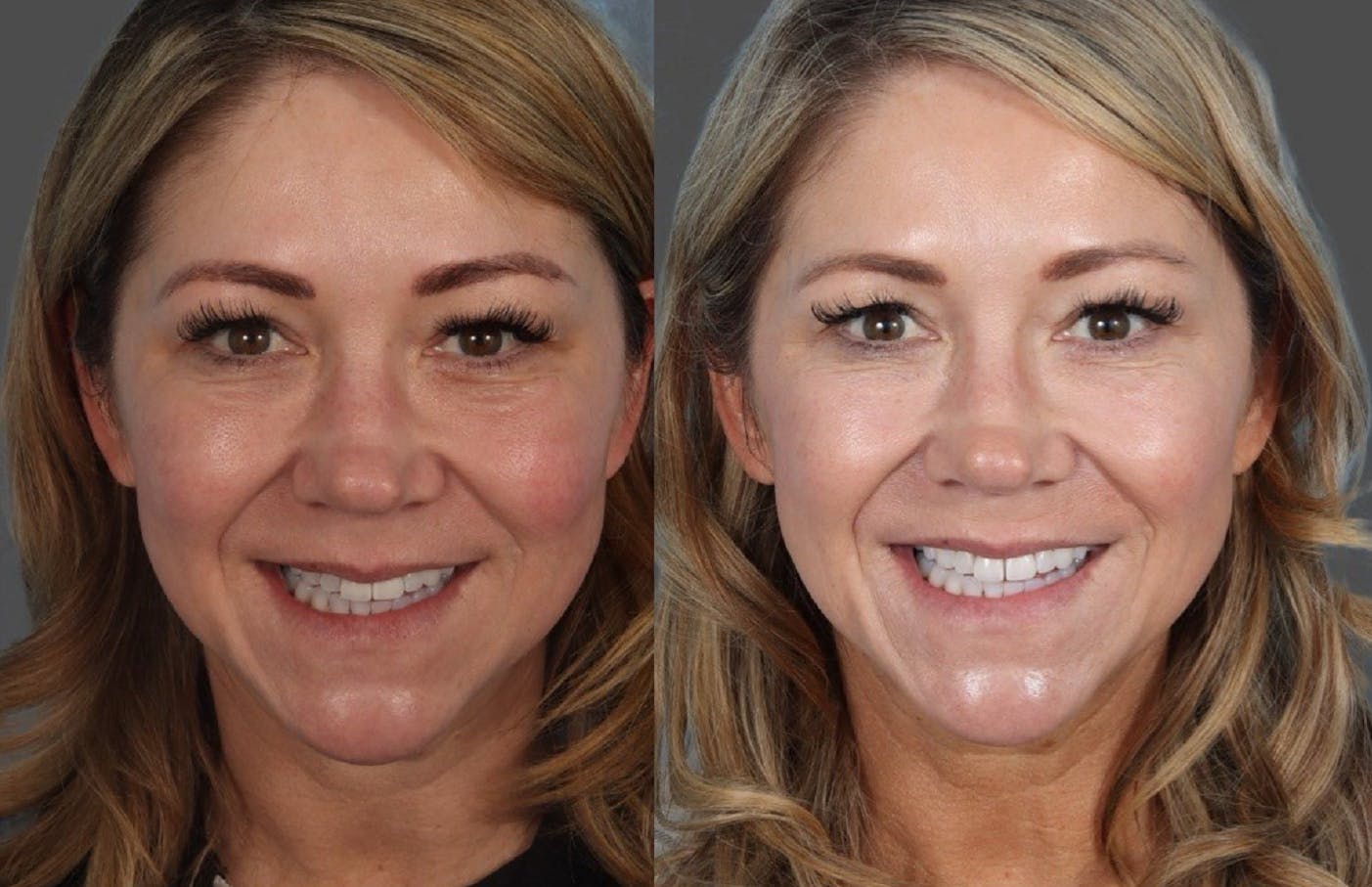 Facial Fat Transfer Before & After Gallery - Patient 213420 - Image 1