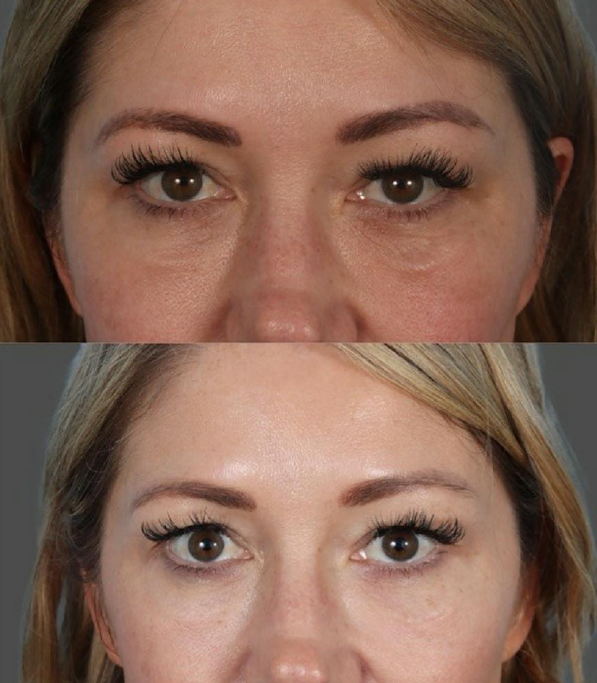 Facial Fat Transfer Before & After Gallery - Patient 213420 - Image 2