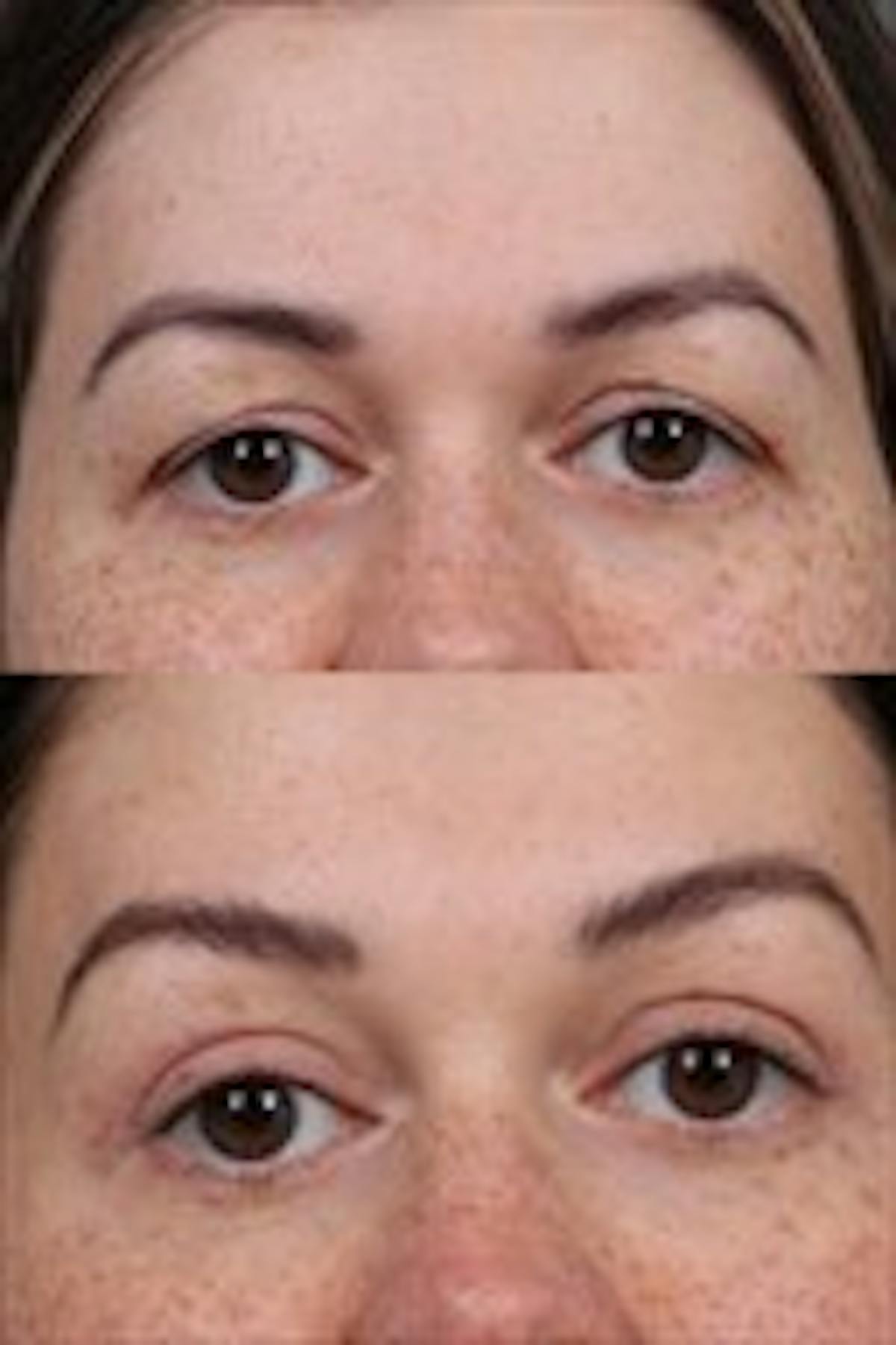 Eyelid Surgery (Blepharoplasty) Before & After Gallery - Patient 354170 - Image 1