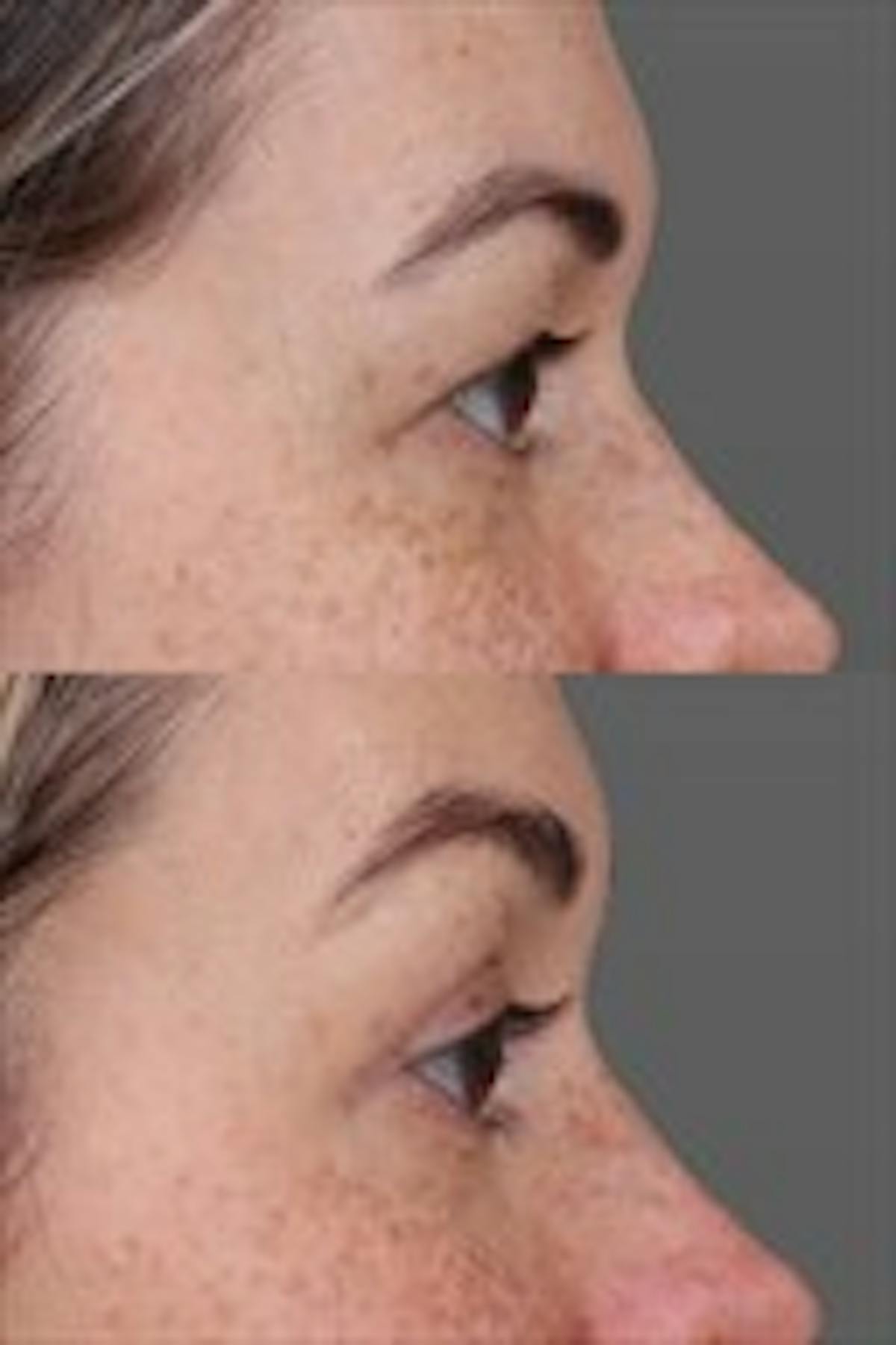 Eyelid Surgery (Blepharoplasty) Before & After Gallery - Patient 354170 - Image 2