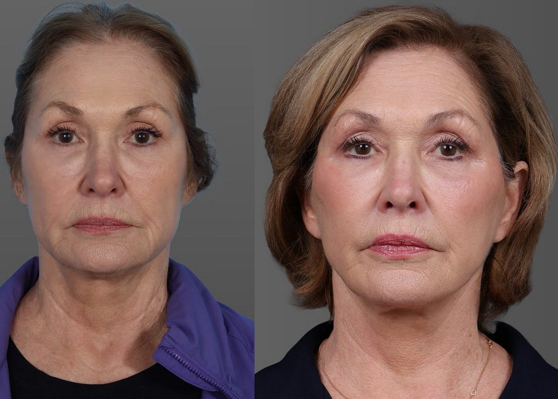 Facial Fat Transfer Before & After Gallery - Patient 347460 - Image 1