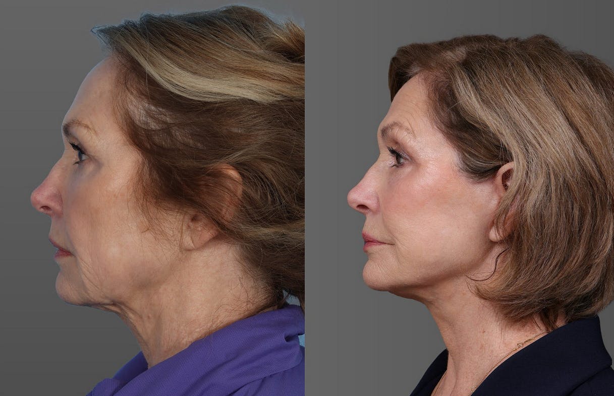Facial Fat Transfer Before & After Gallery - Patient 347460 - Image 5