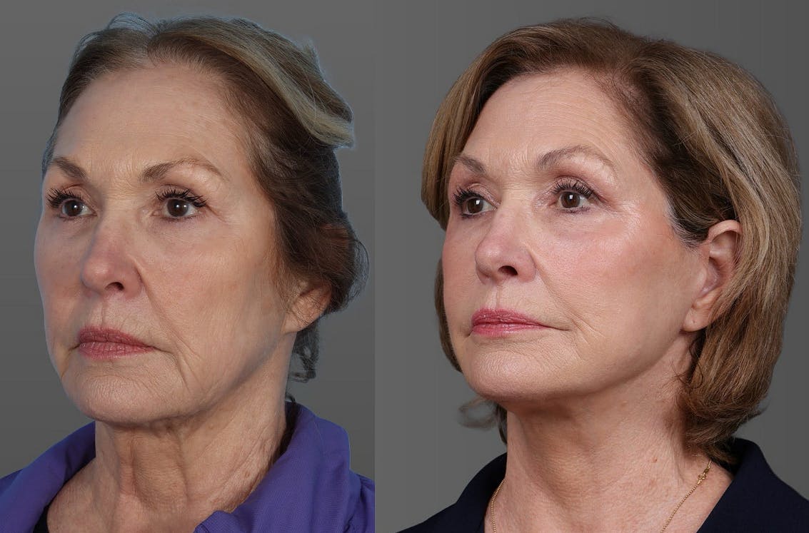 Facial Fat Transfer Before & After Gallery - Patient 347460 - Image 4