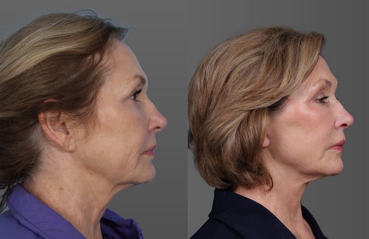 Eyelid Surgery (Blepharoplasty) Before & After Gallery - Patient 392393 - Image 3