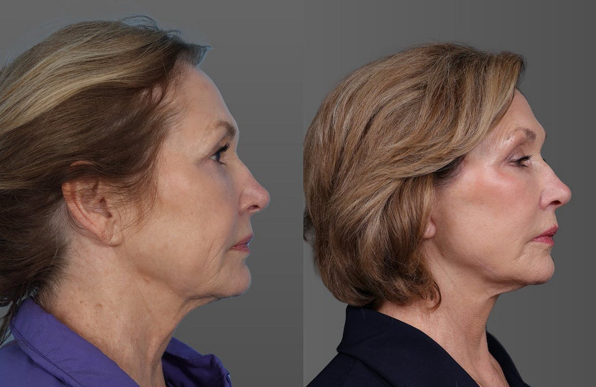 Facial Fat Transfer Before & After Gallery - Patient 347460 - Image 3