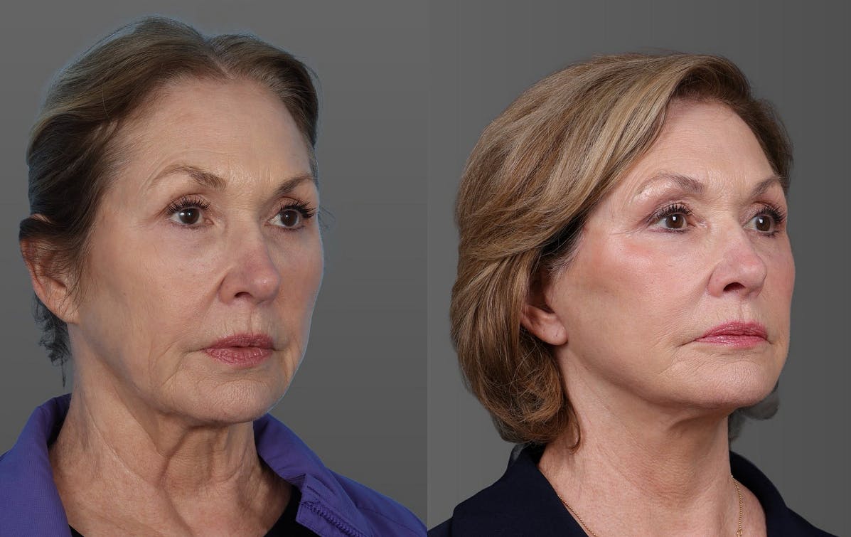Facial Fat Transfer Before & After Gallery - Patient 347460 - Image 2