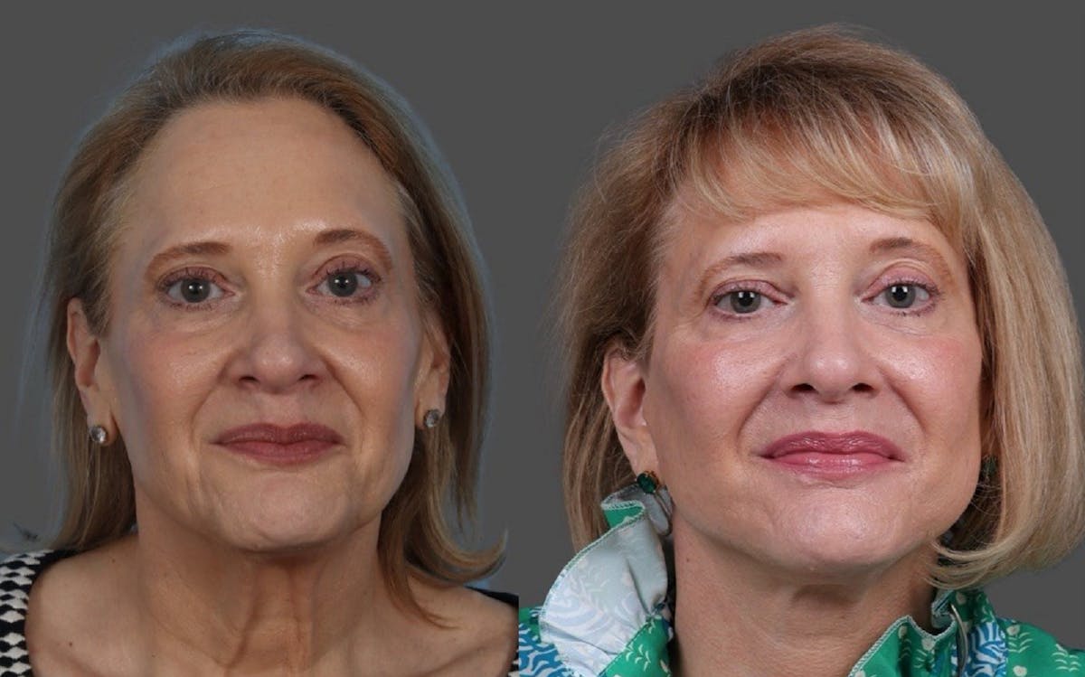 Facelift Before & After Gallery - Patient 151321 - Image 1