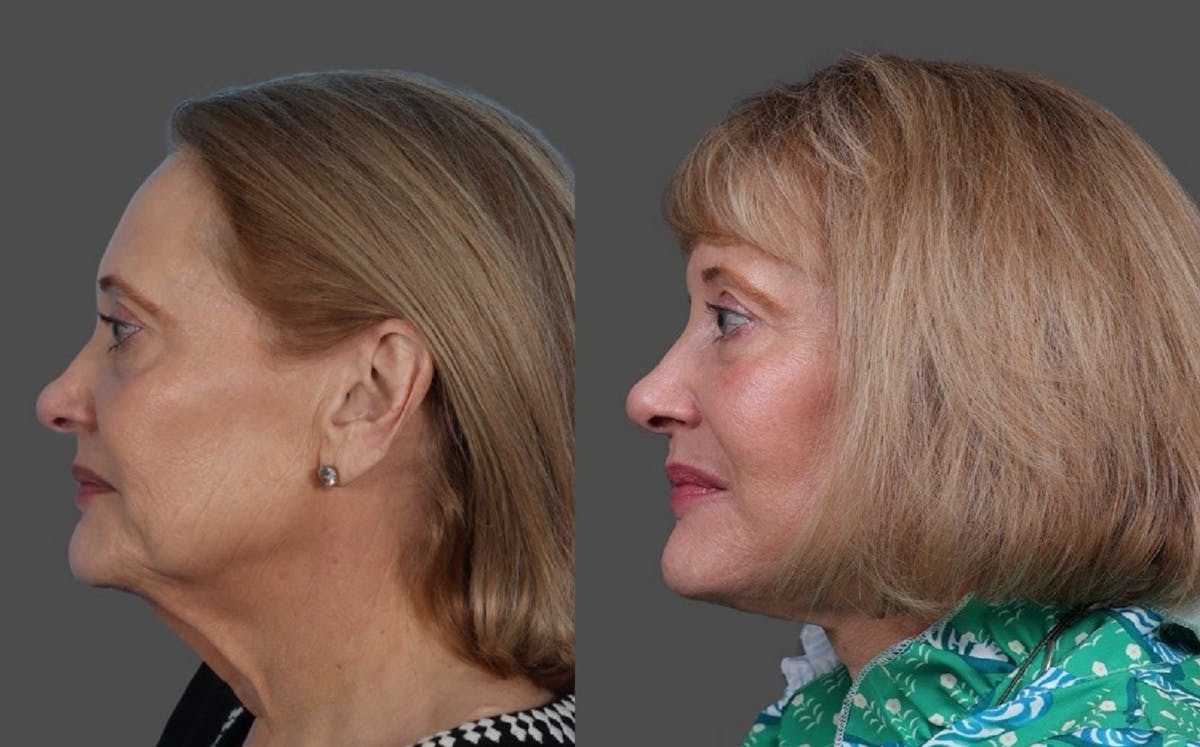 Facelift Before & After Gallery - Patient 151321 - Image 5