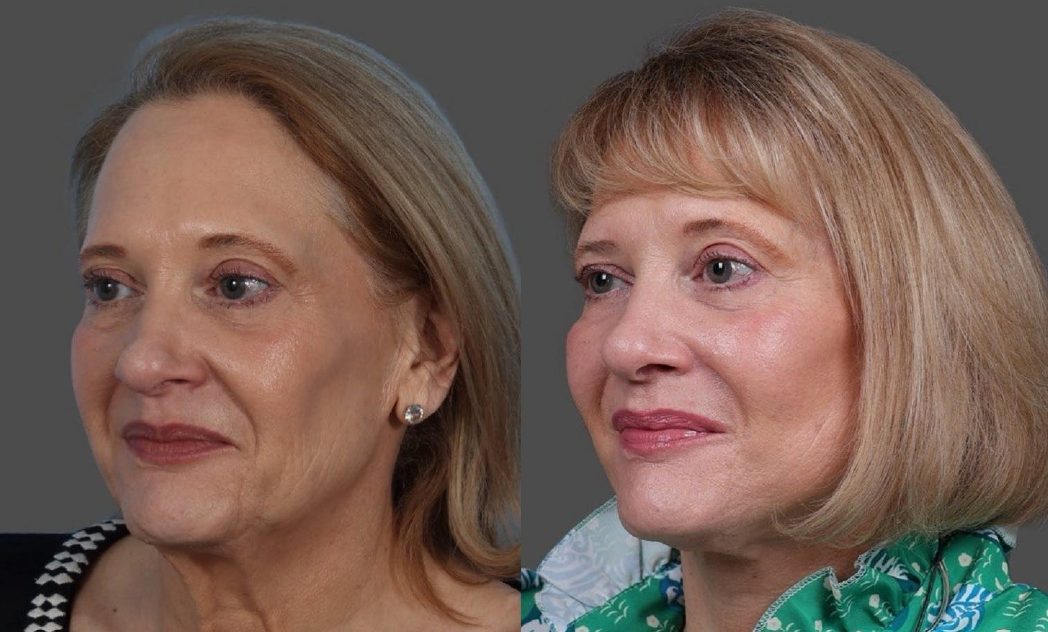 Facelift Before & After Gallery - Patient 151321 - Image 4