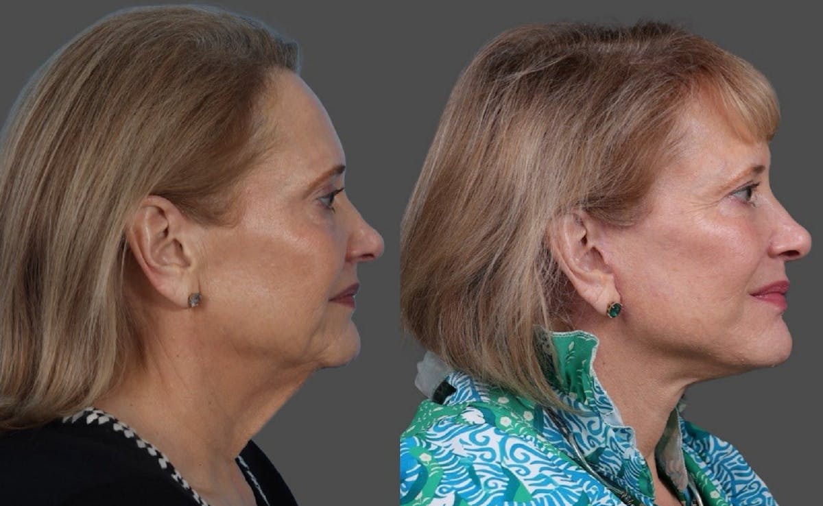 Facelift Before & After Gallery - Patient 151321 - Image 3