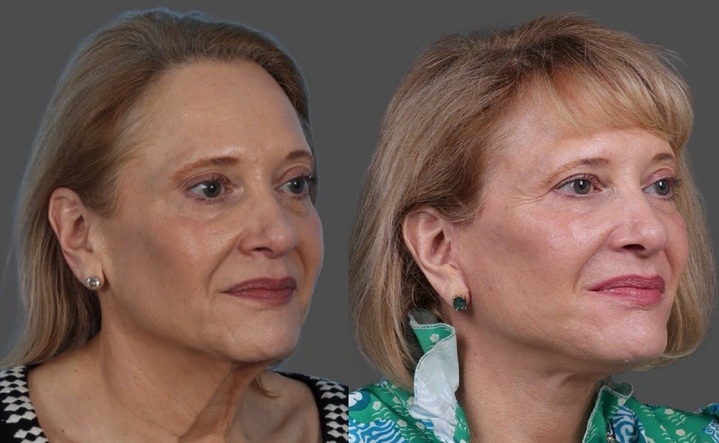 Facelift Before & After Gallery - Patient 151321 - Image 2