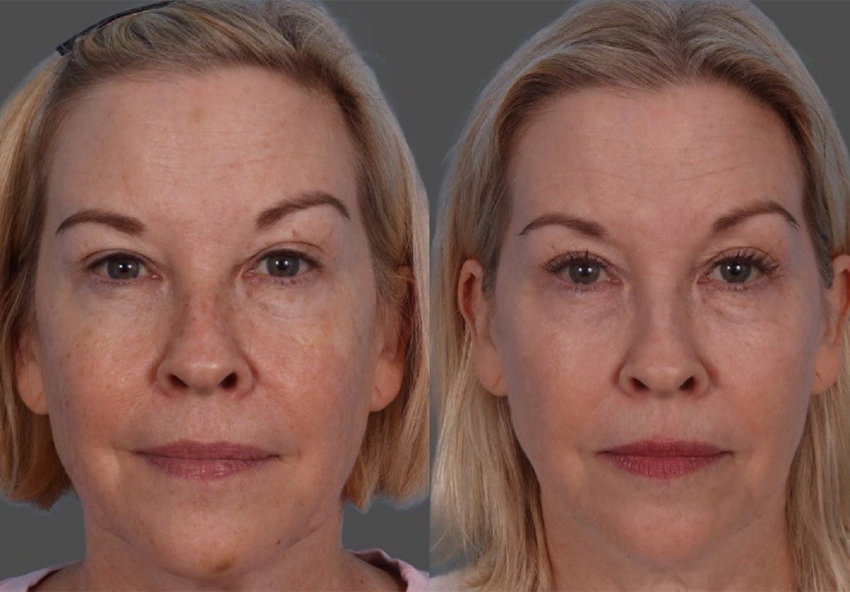 Lasers Before & After Gallery - Patient 553485 - Image 1