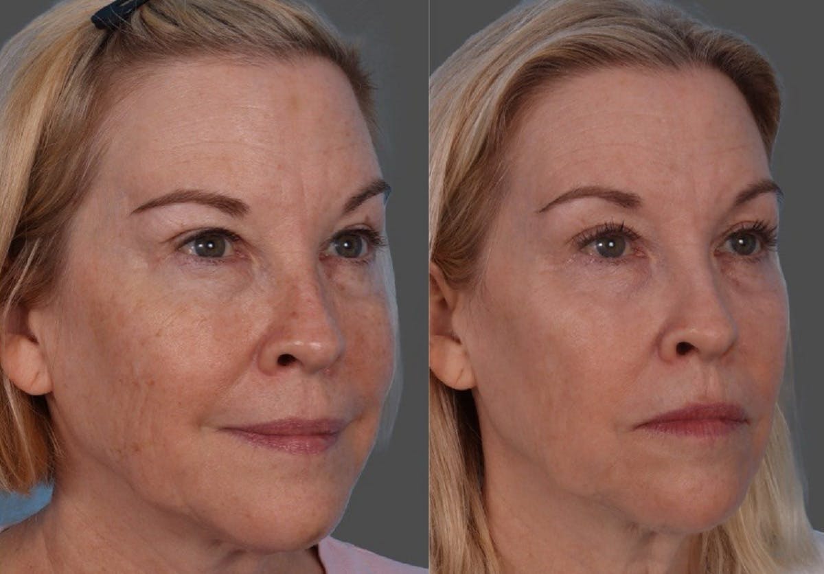 Lasers Before & After Gallery - Patient 553485 - Image 2