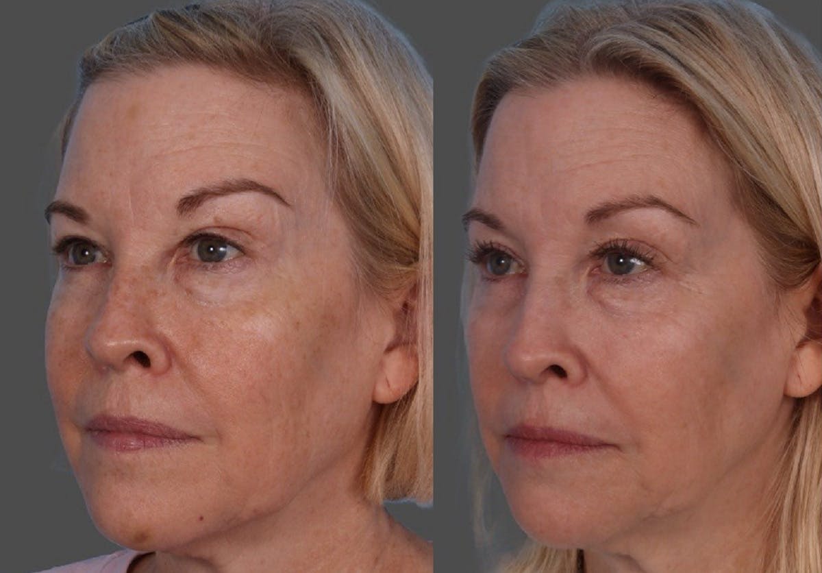 Lasers Before & After Gallery - Patient 553485 - Image 3