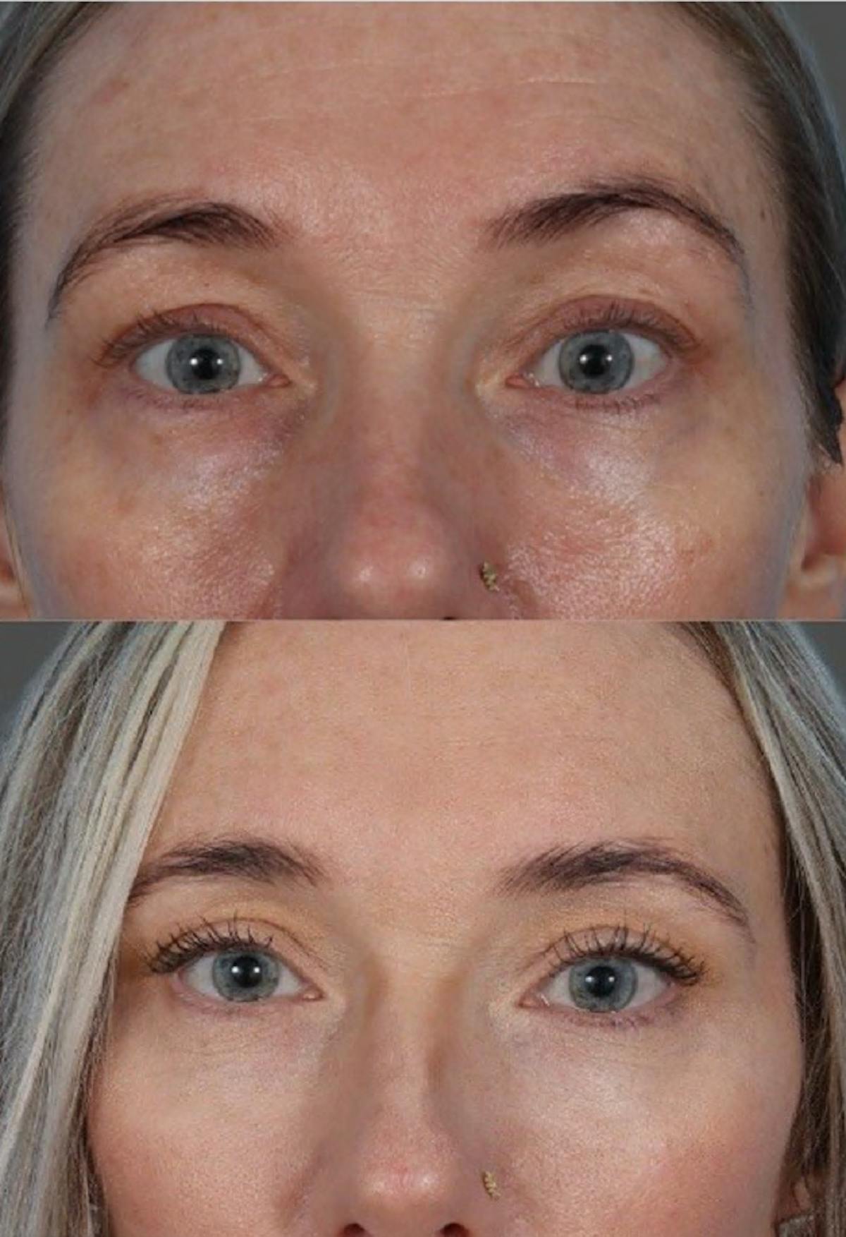 Eyelid Surgery (Blepharoplasty) Before & After Gallery - Patient 144843 - Image 6