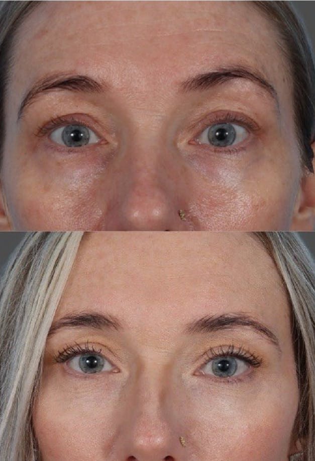 Submental Microliposuction Before & After Gallery - Patient 412494 - Image 6