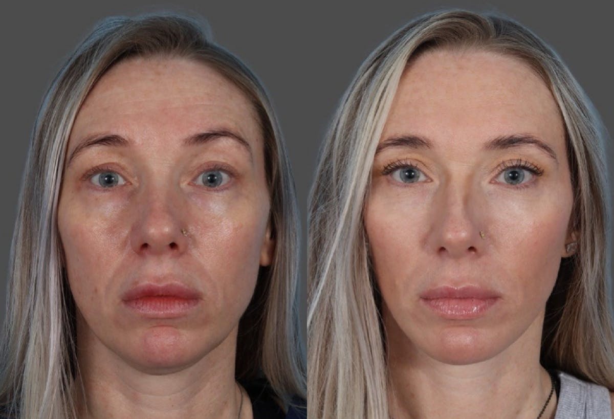 Eyelid Surgery (Blepharoplasty) Before & After Gallery - Patient 144843 - Image 1