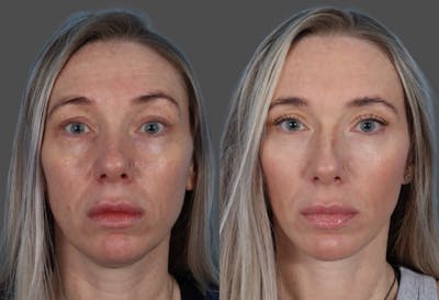 Eyelid Surgery (Blepharoplasty) Before & After Gallery - Patient 144843 - Image 1