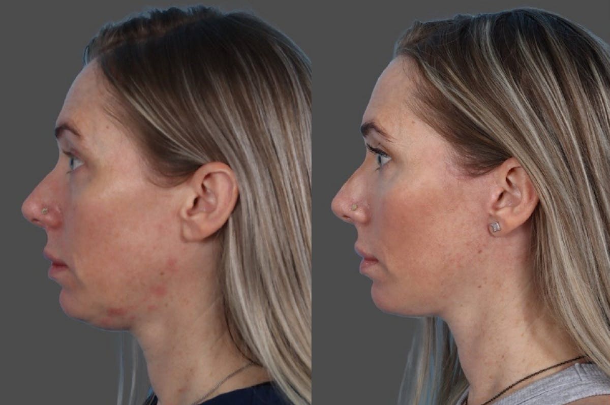 Eyelid Surgery (Blepharoplasty) Before & After Gallery - Patient 144843 - Image 5