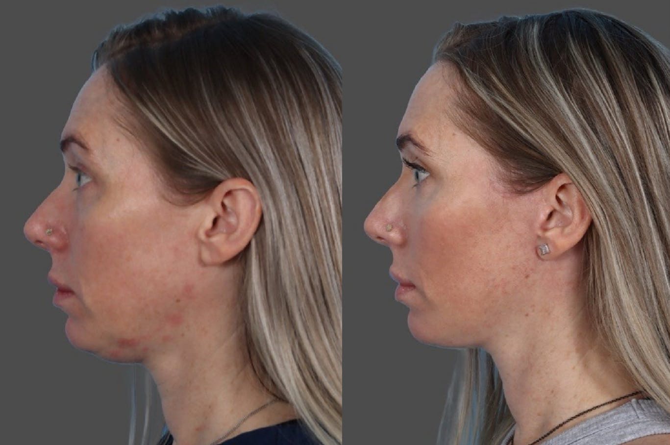 Submental Microliposuction Before & After Gallery - Patient 412494 - Image 5