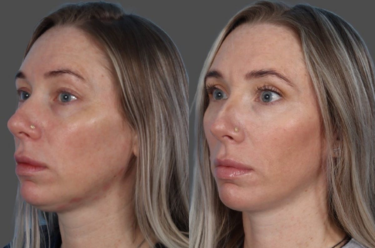 Eyelid Surgery (Blepharoplasty) Before & After Gallery - Patient 144843 - Image 4