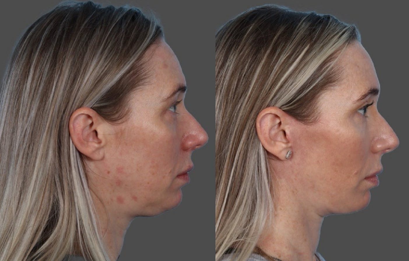 Submental Microliposuction Before & After Gallery - Patient 412494 - Image 3