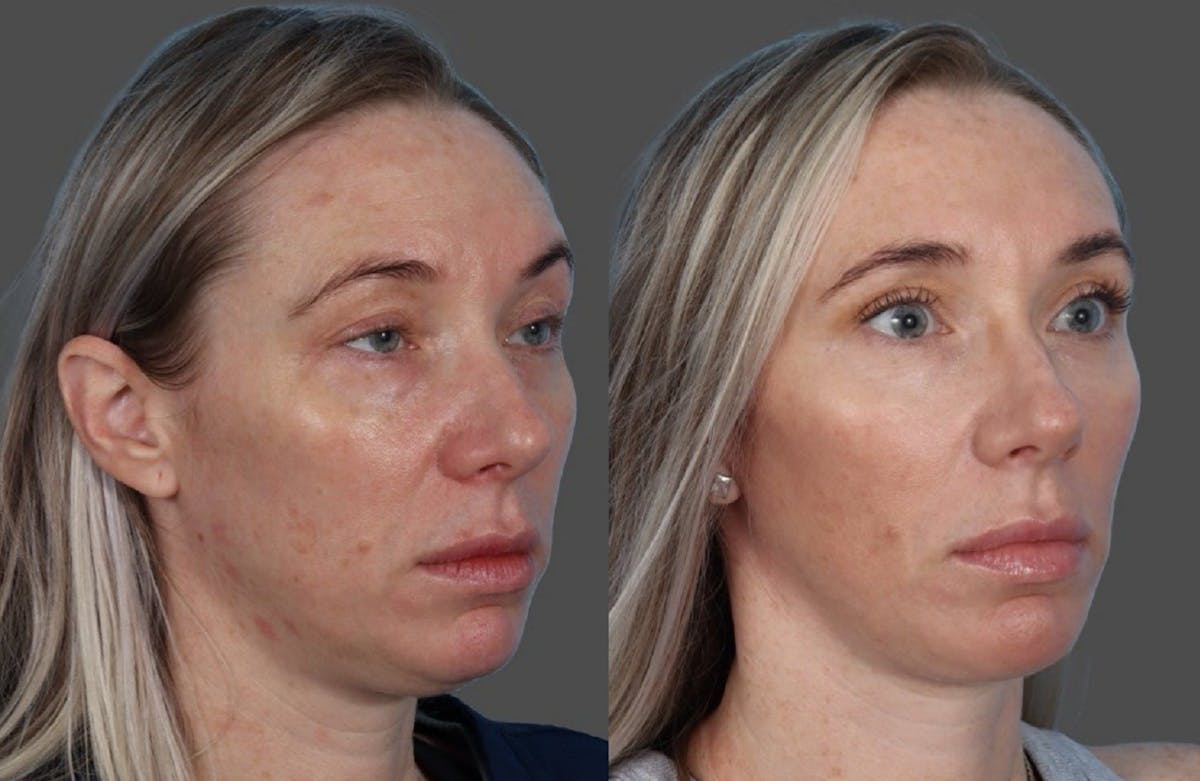 Eyelid Surgery (Blepharoplasty) Before & After Gallery - Patient 144843 - Image 2