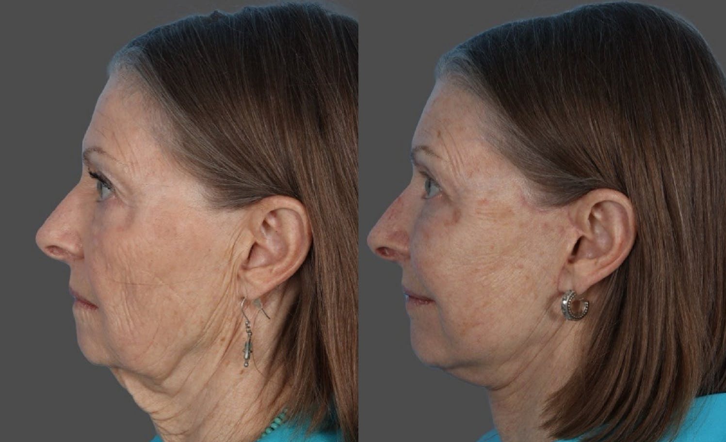 Facial Fat Transfer Before & After Gallery - Patient 370640 - Image 5