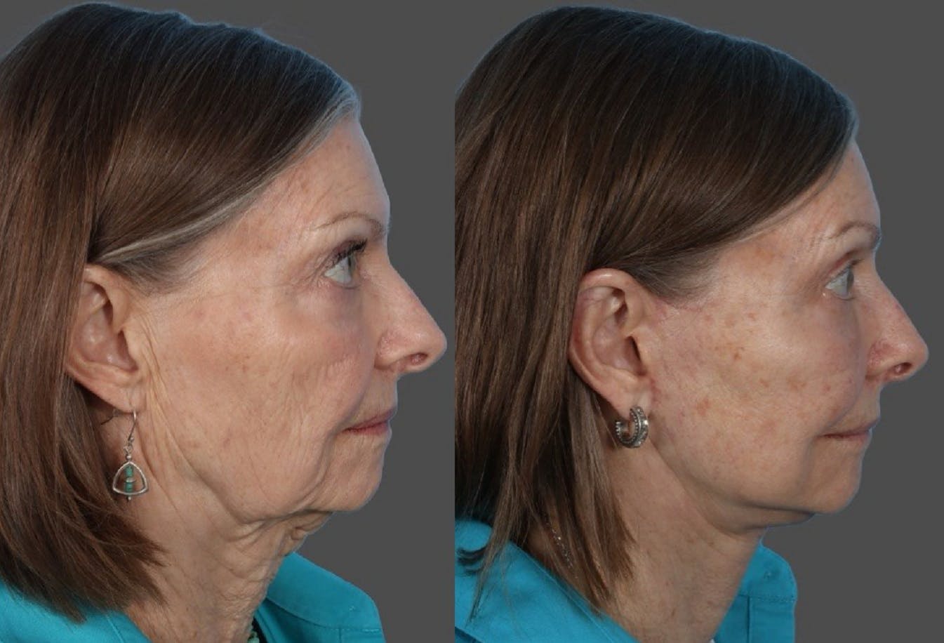 Facial Fat Transfer Before & After Gallery - Patient 370640 - Image 3