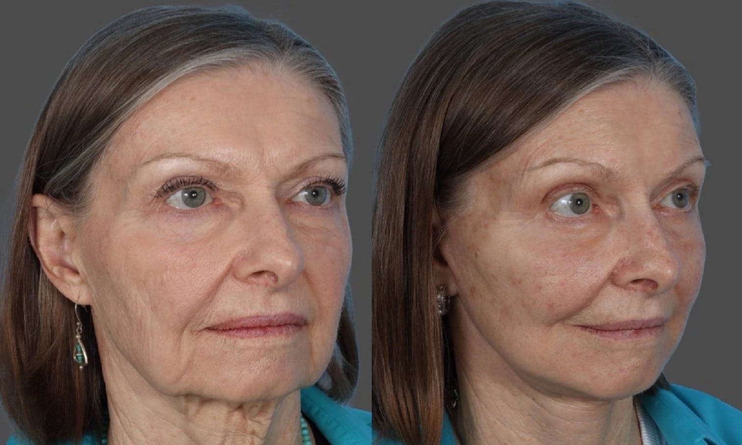 Facial Fat Transfer Before & After Gallery - Patient 370640 - Image 2