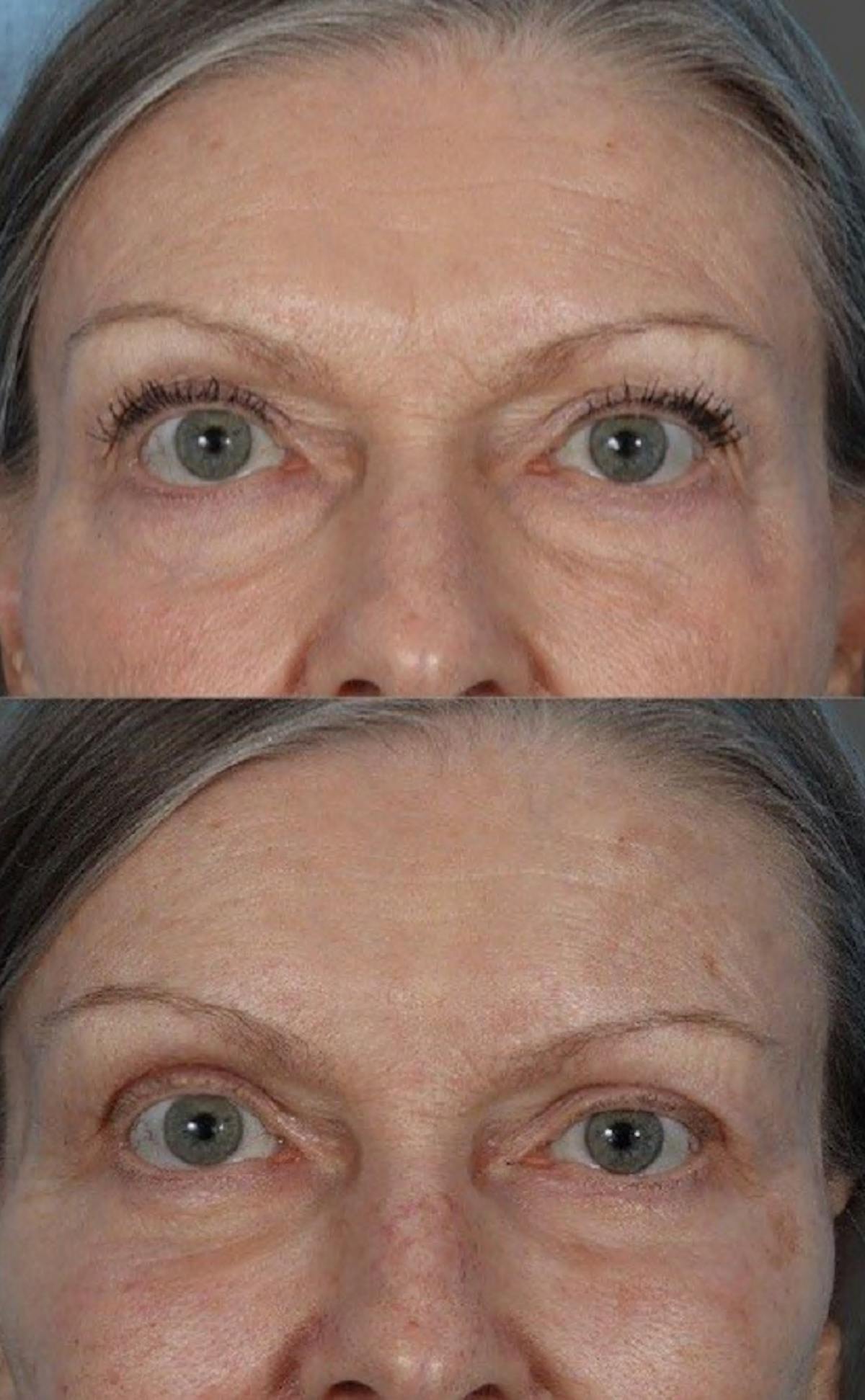 Eyelid Surgery (Blepharoplasty) Before & After Gallery - Patient 110844 - Image 6