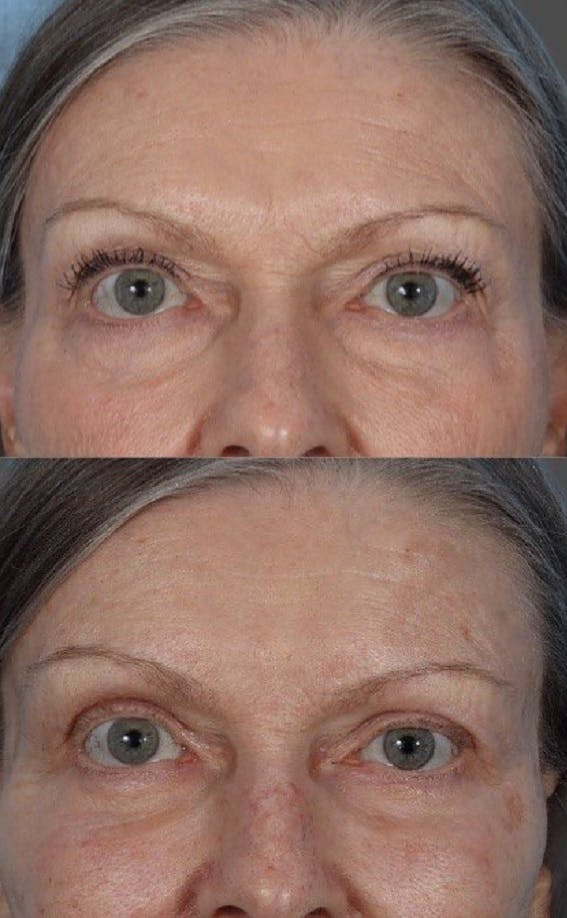 Facial Fat Transfer Before & After Gallery - Patient 370640 - Image 6