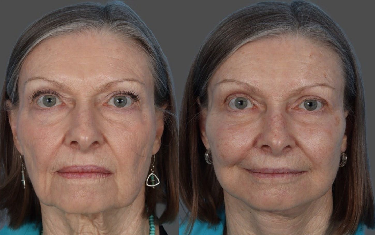 Facial Fat Transfer Before & After Gallery - Patient 370640 - Image 1