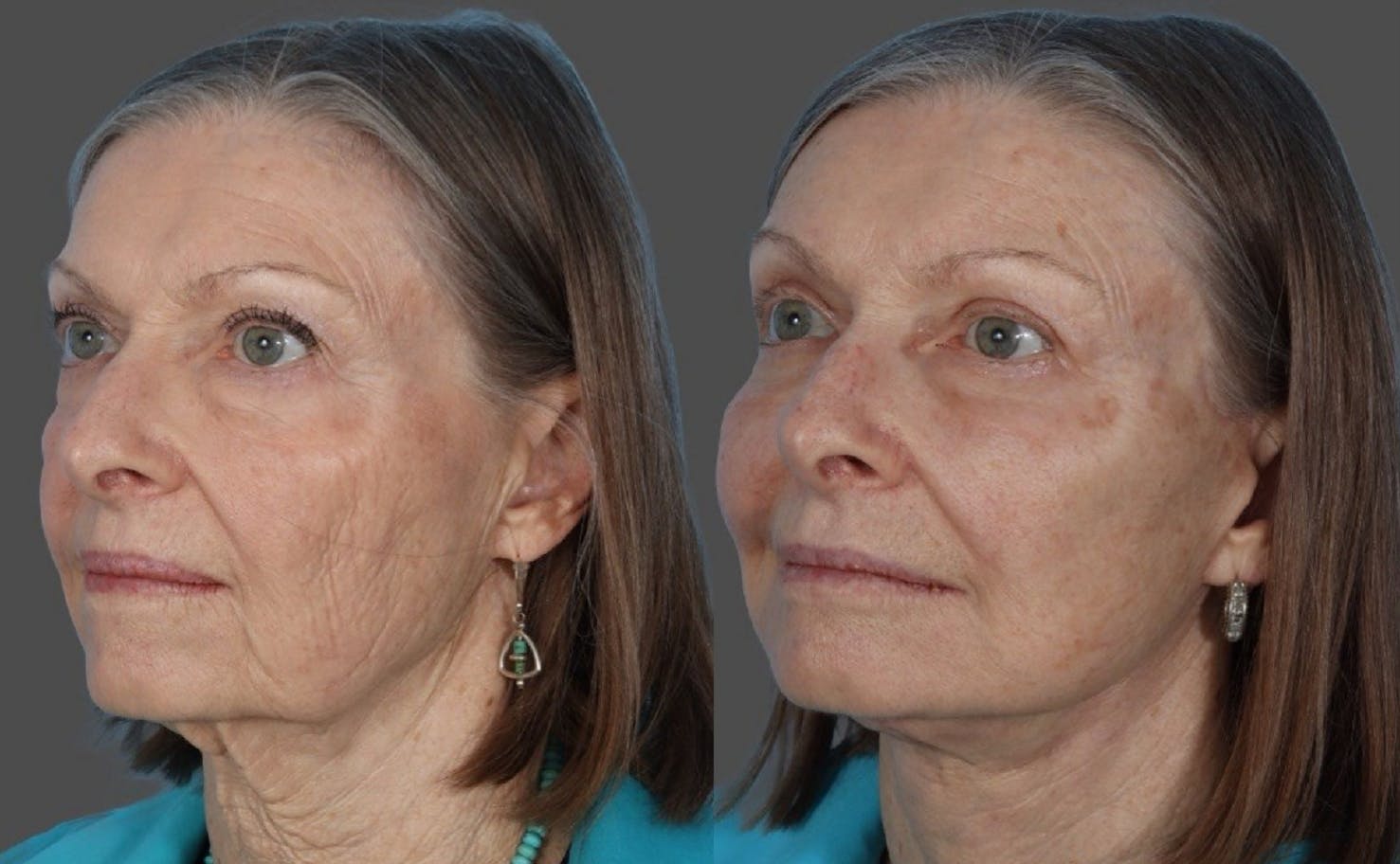 Facial Fat Transfer Before & After Gallery - Patient 370640 - Image 4