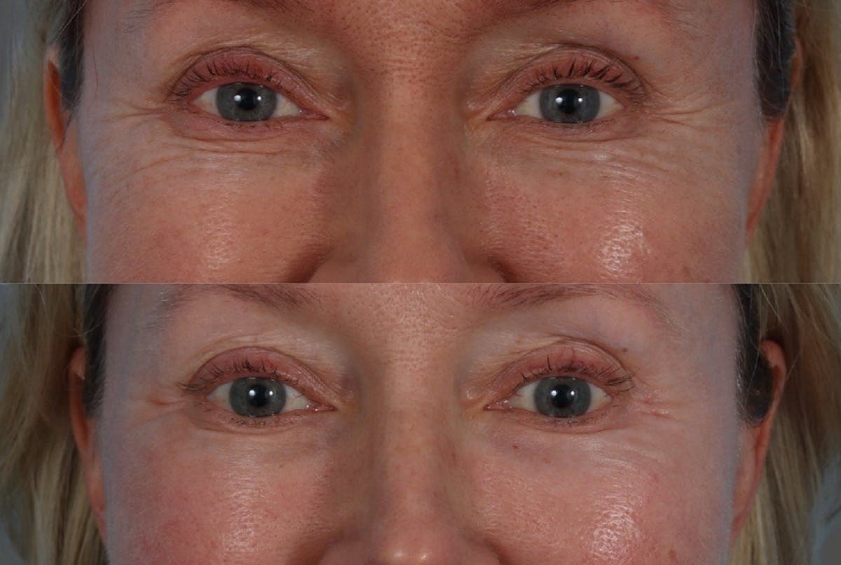 CO2 Fractional Laser Before & After Gallery - Patient 166017 - Image 6