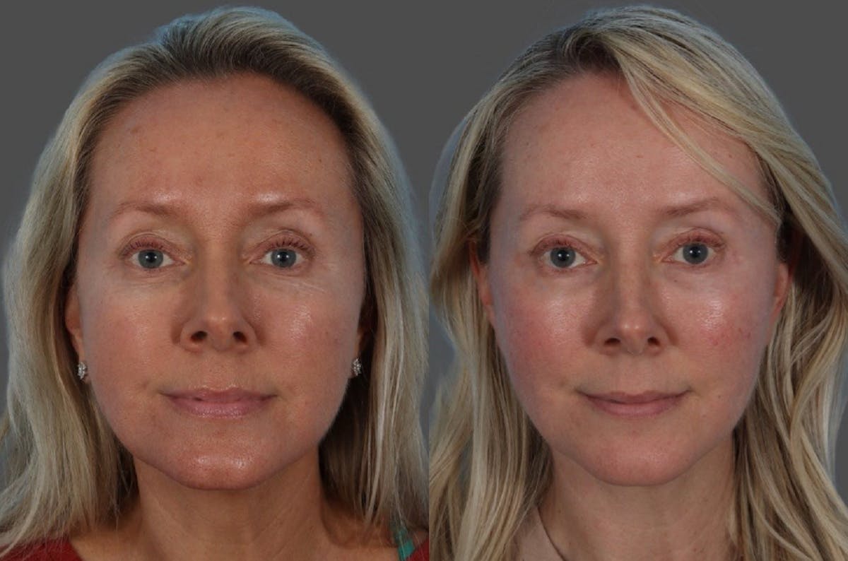 CO2 Fractional Laser Before & After Gallery - Patient 166017 - Image 1