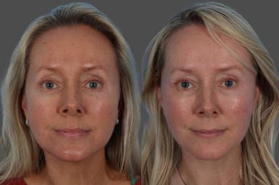 CO2 Fractional Laser Before & After Gallery - Patient 166017 - Image 1