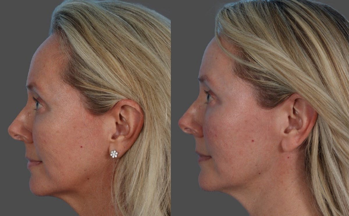 CO2 Fractional Laser Before & After Gallery - Patient 166017 - Image 5