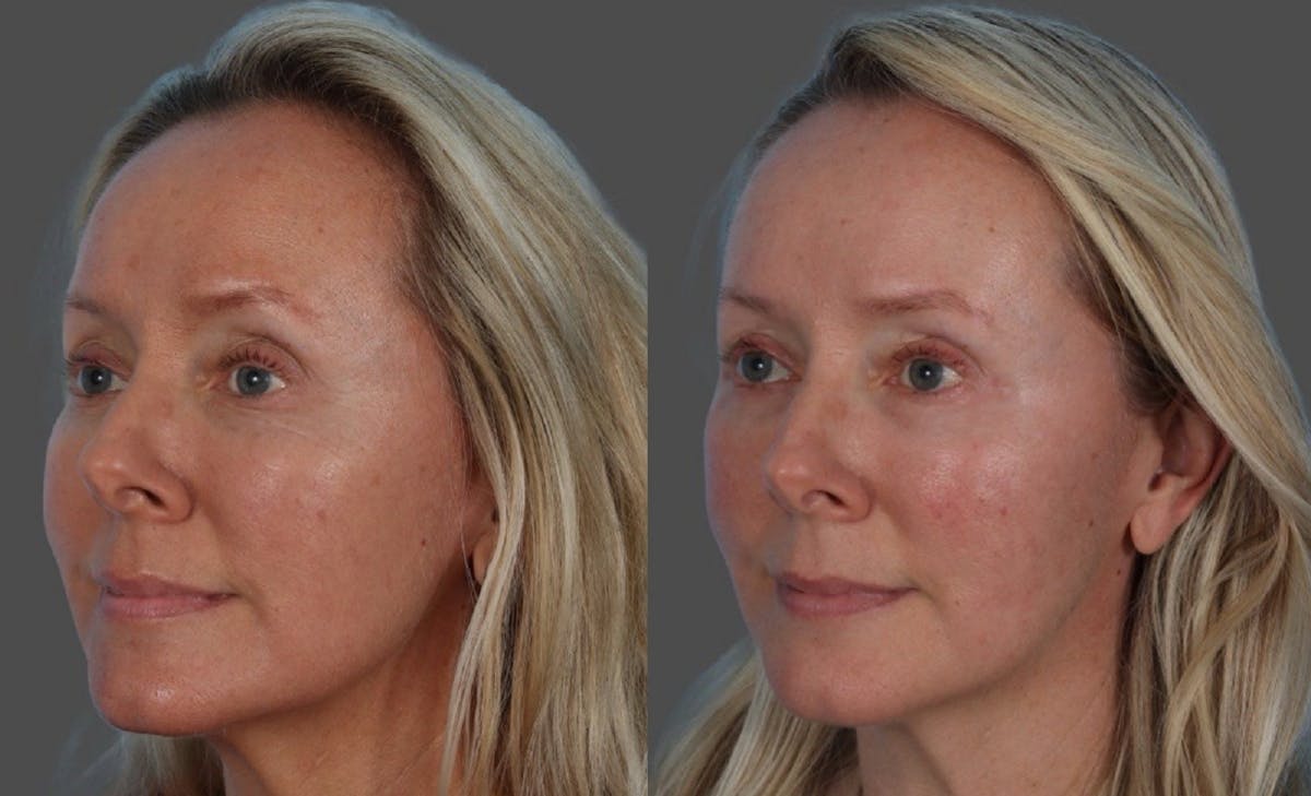 CO2 Fractional Laser Before & After Gallery - Patient 166017 - Image 4