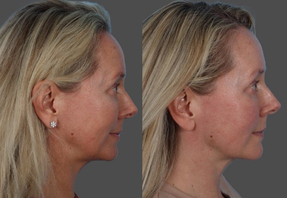CO2 Fractional Laser Before & After Gallery - Patient 166017 - Image 3