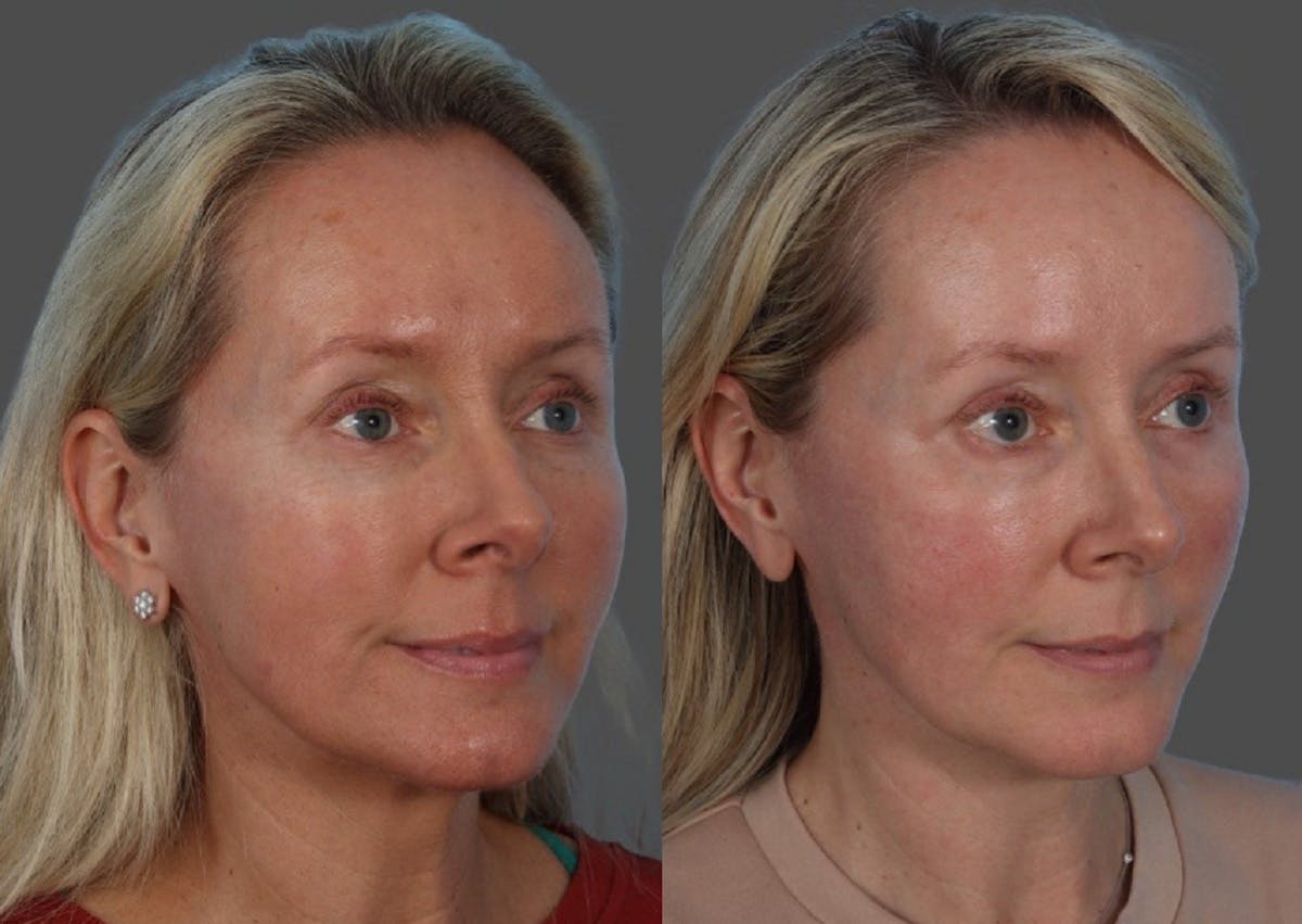 CO2 Fractional Laser Before & After Gallery - Patient 166017 - Image 2