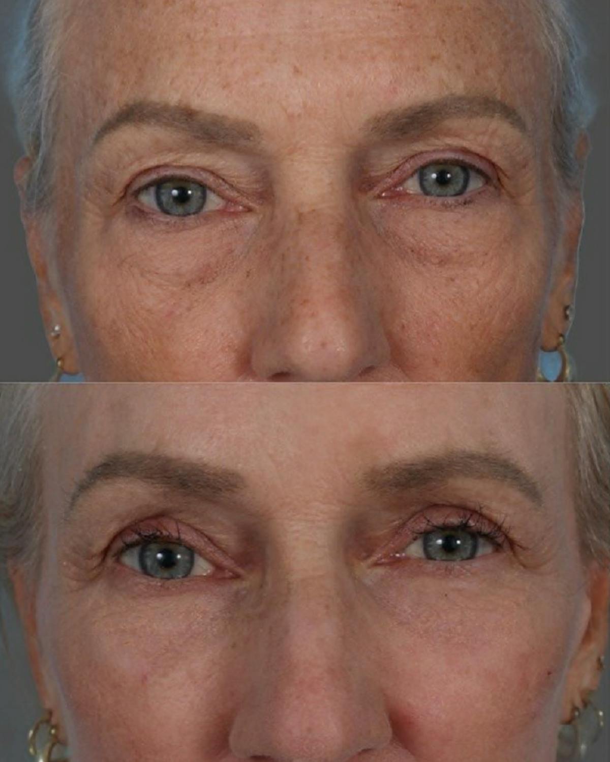 Facial Fat Transfer Before & After Gallery - Patient 138398 - Image 6