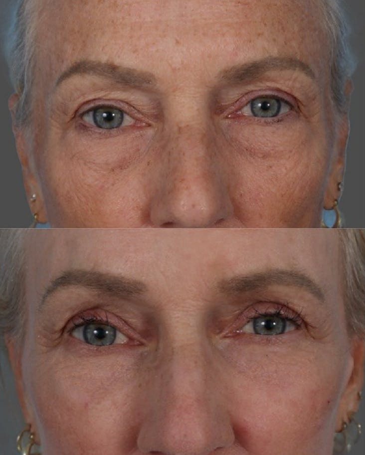 CO2 Fractional Laser Before & After Gallery - Patient 180301 - Image 6
