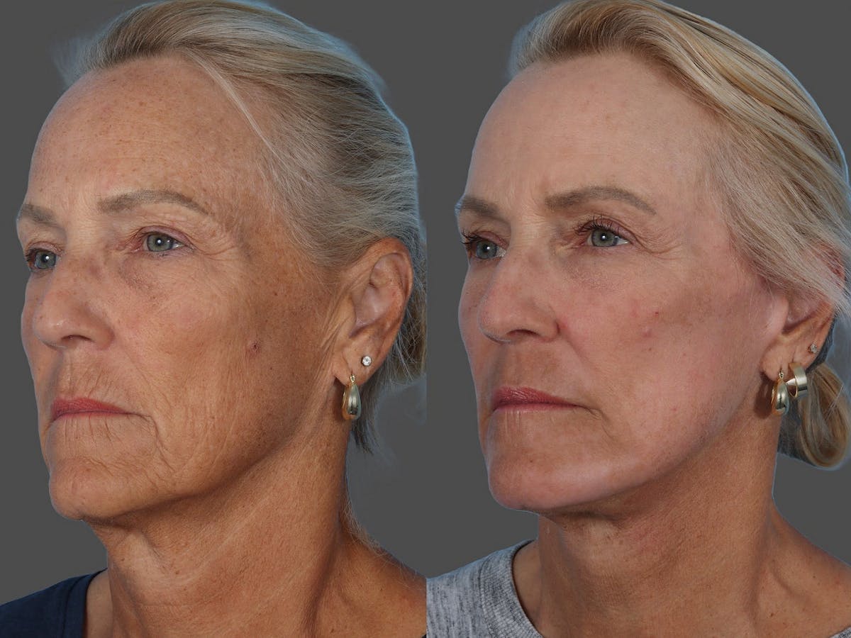 Facial Fat Transfer Before & After Gallery - Patient 138398 - Image 4