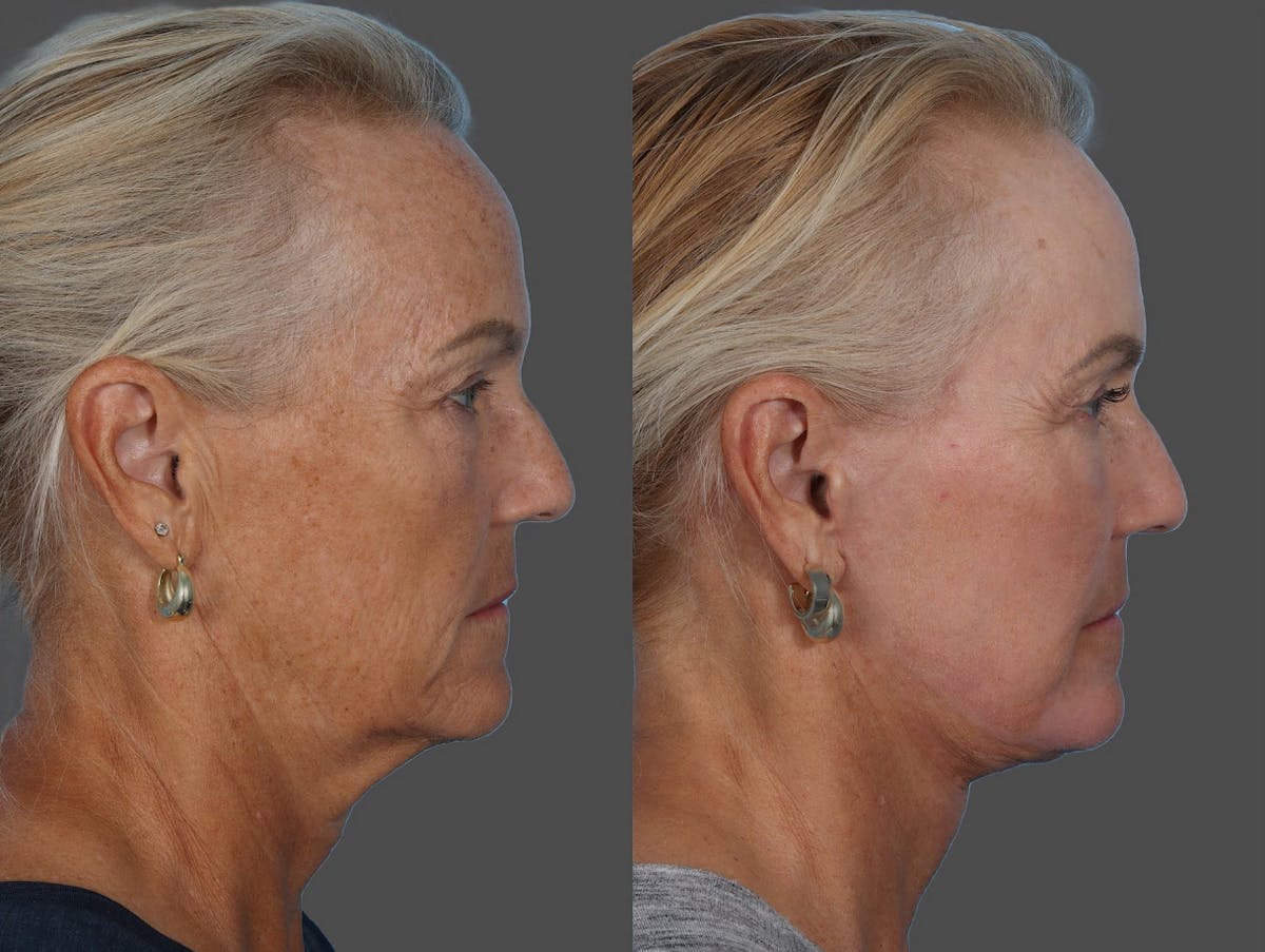Facial Fat Transfer Before & After Gallery - Patient 138398 - Image 3