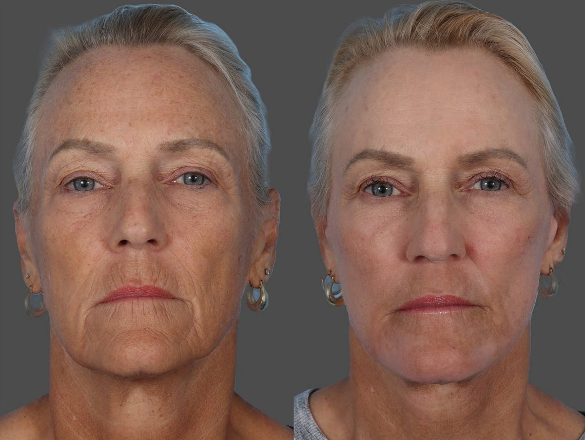Facial Fat Transfer Before & After Gallery - Patient 138398 - Image 1