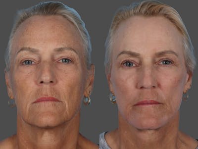 Eyelid Surgery (Blepharoplasty) Before & After Gallery - Patient 157506 - Image 1